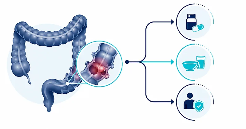 Acute diverticulitis treatment pathway showing antibiotic decisions and elective resection timing in the sigmoid colon