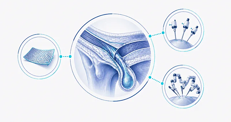 Inguinal hernia repair anatomy diagram comparing open Lichtenstein mesh, laparoscopic TAPP/TEP, and robotic surgical approaches
