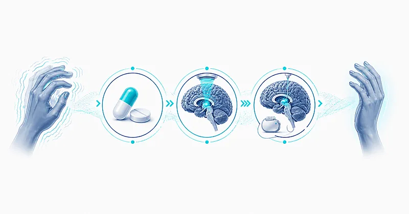 MASLD treatment overview showing liver fibrosis staging, resmetirom, and GLP-1 receptor agonist therapy for clinicians