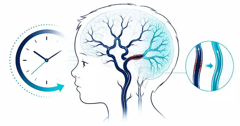 Pediatric stroke illustration of a child's cerebral arteries with a large-vessel occlusion and reperfusion pathway